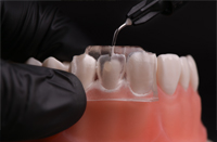 歯を削らない治療システム